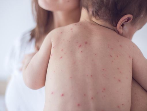 Fiche Infos - Reconnaître la varicelle de l'enfant